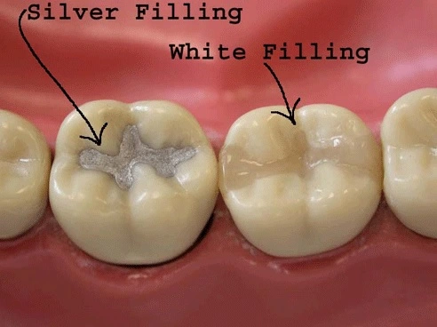 Dental Restoration(Filling)