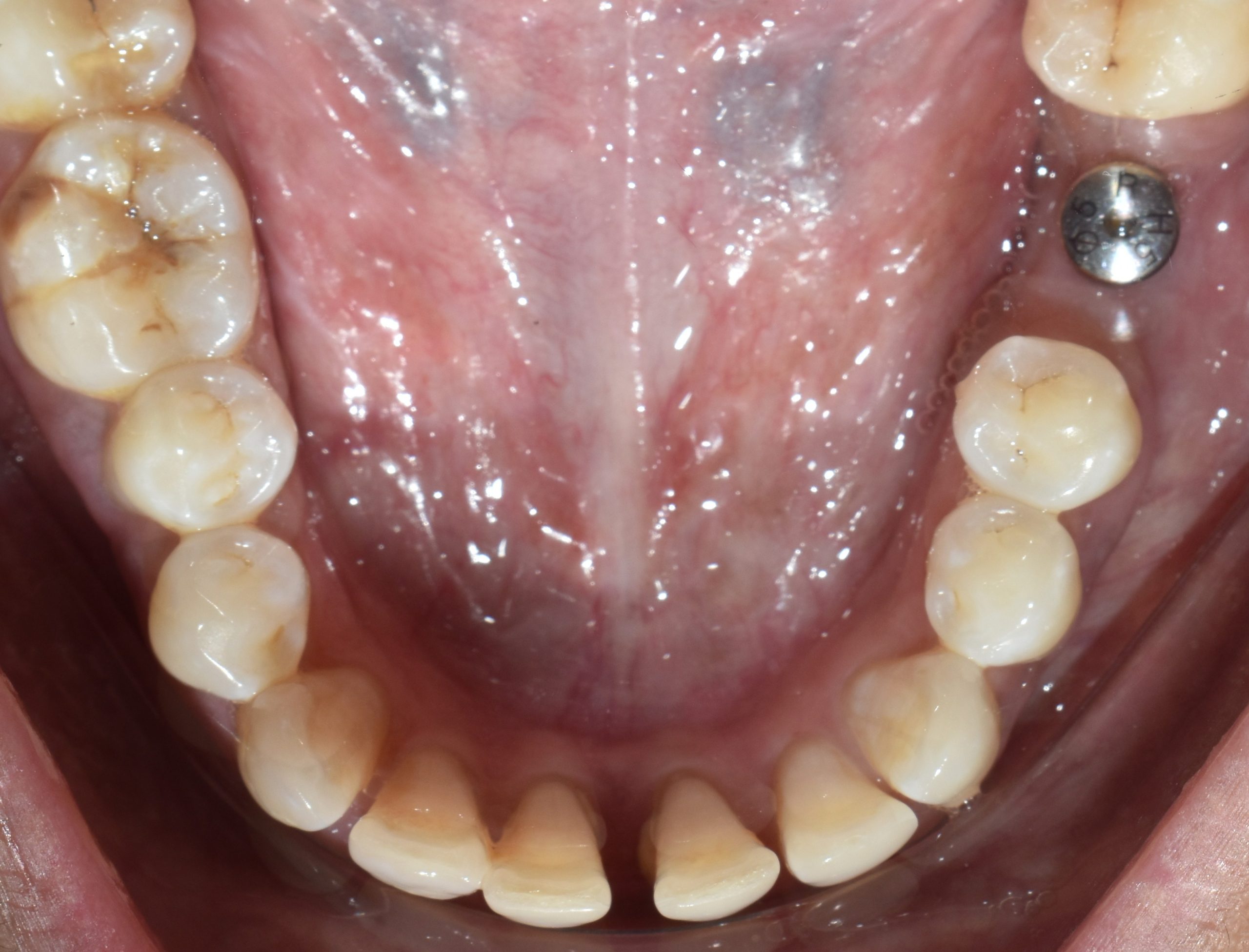 Dental Implants: The Ultimate Solution for Multiple Tooth Loss