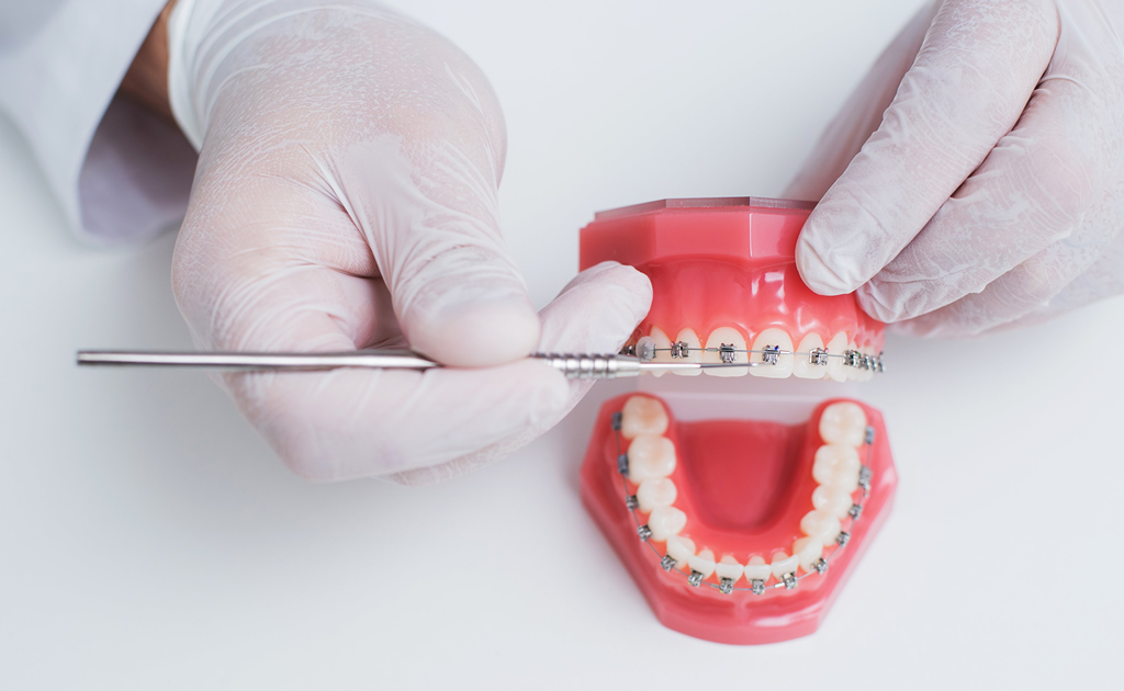 Top 10 Myths About Braces Busted